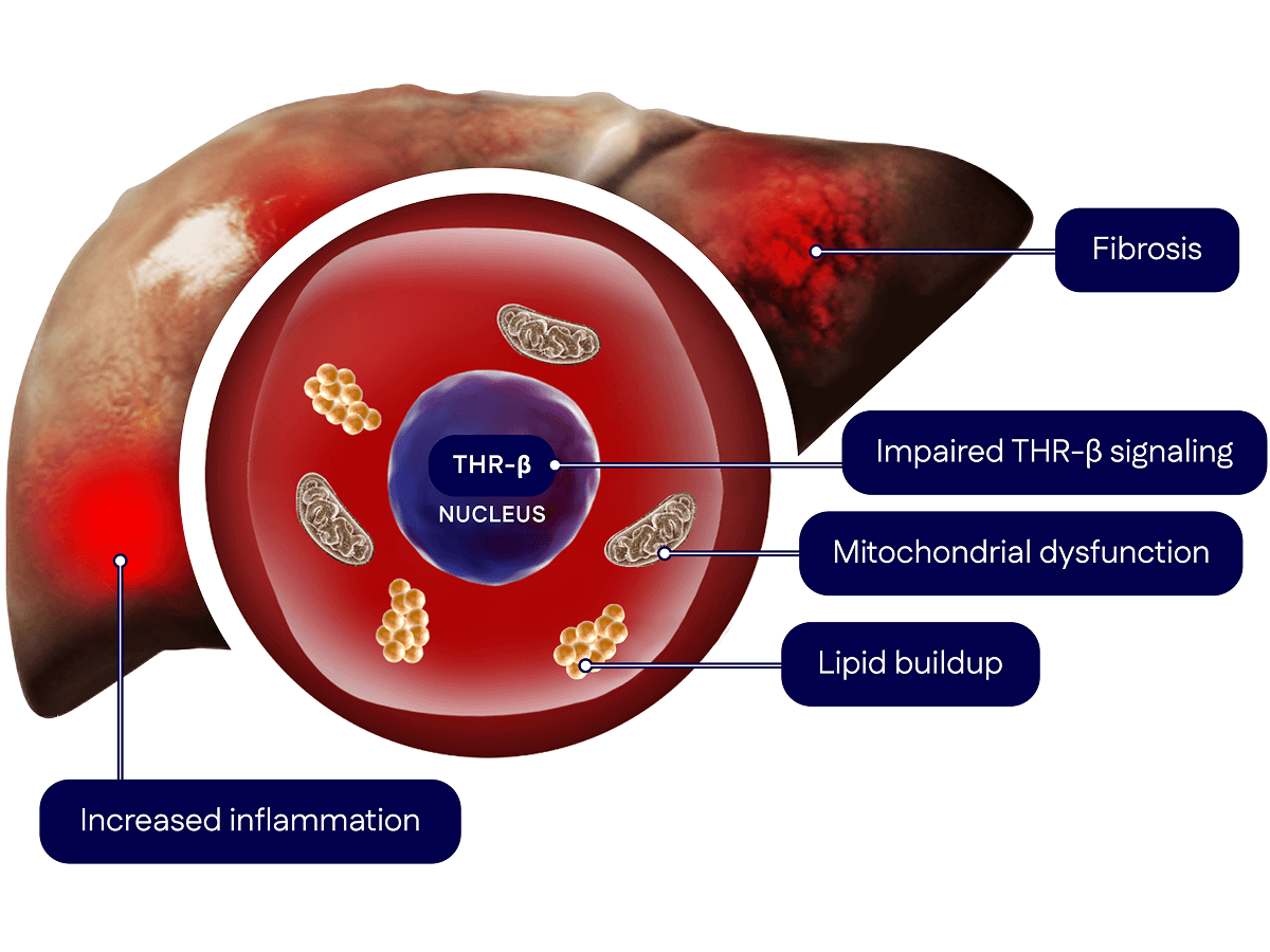 Illustration of a liver cell showing disruptions: increased inflammation, lipid buildup, impaired thyroid hormone receptor-beta signaling and mitochondrial dysfunction.